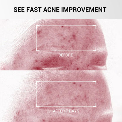 Acne Buster: Fast Clear & Deep Treatment