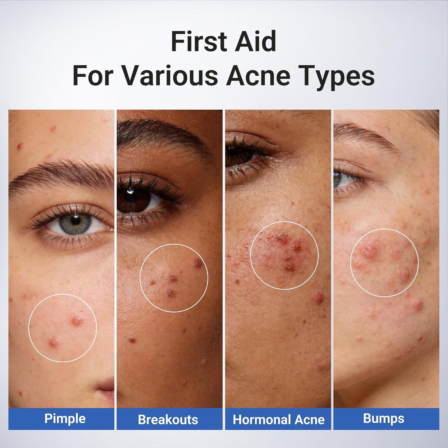 Acne Buster: Fast Clear & Deep Treatment